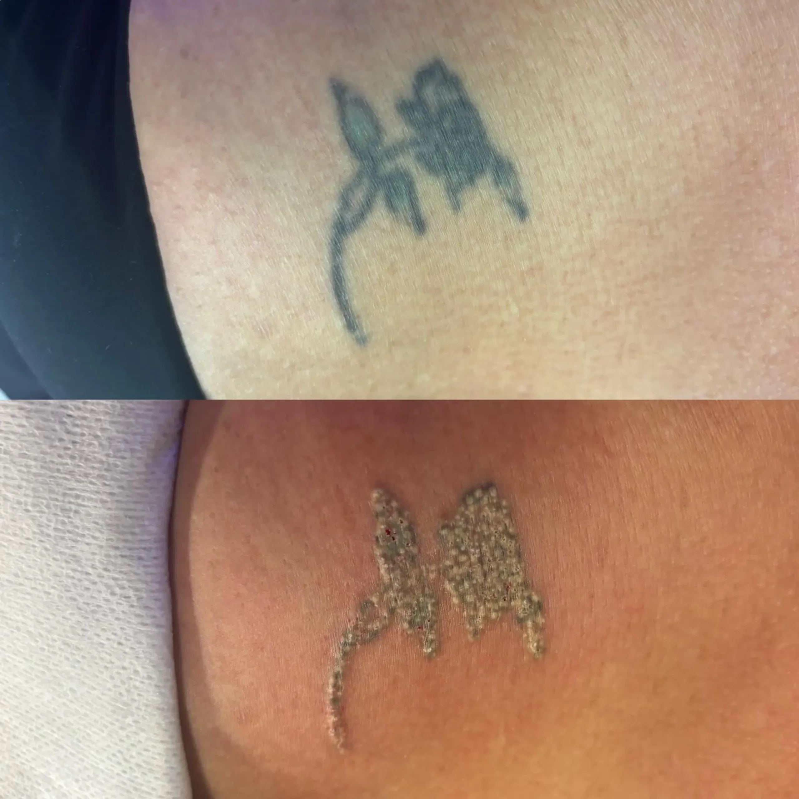 cost of laser tattoo removal