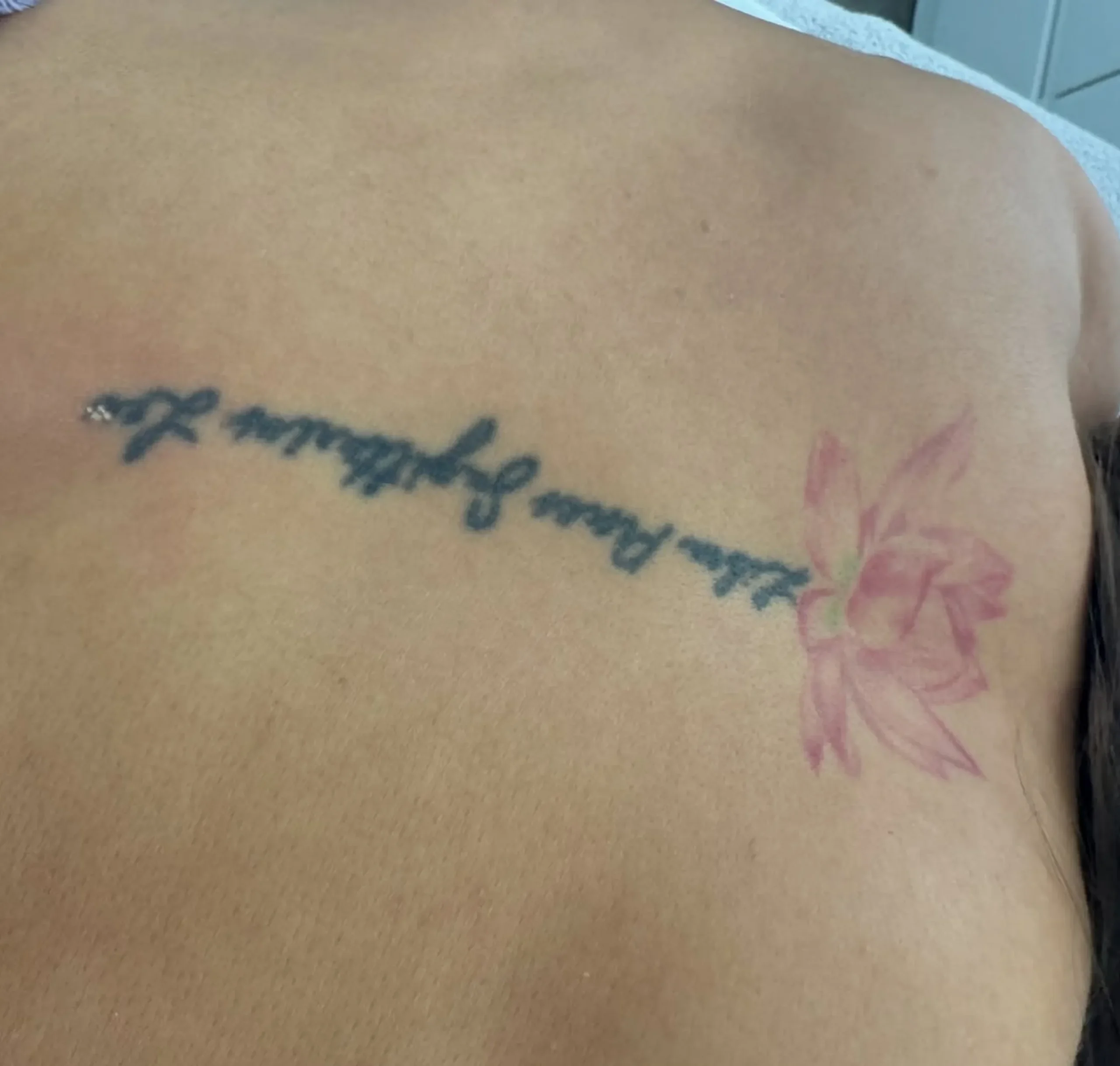 laser tattoo removal melbourne cbd