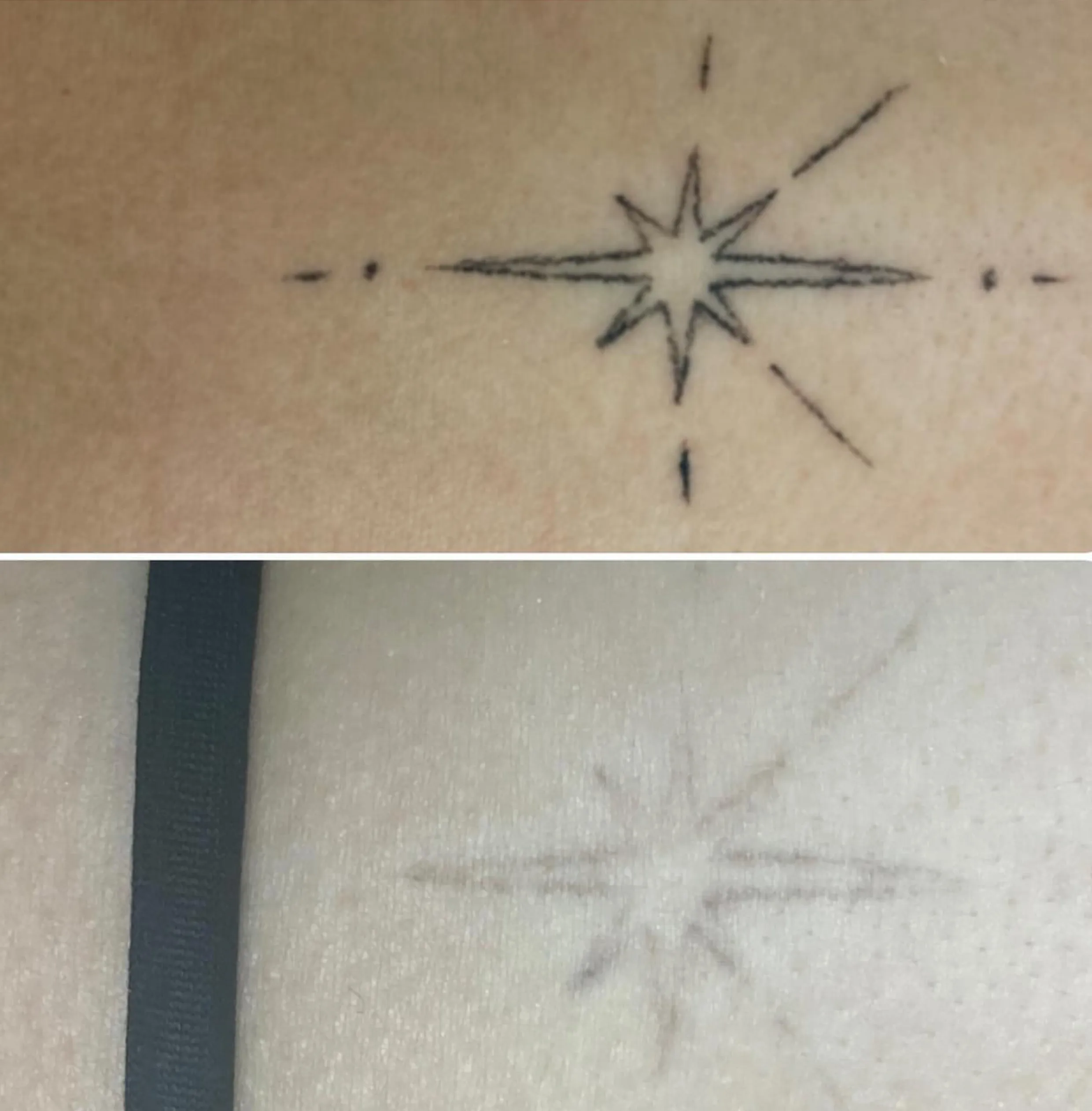 remove tattoo laser