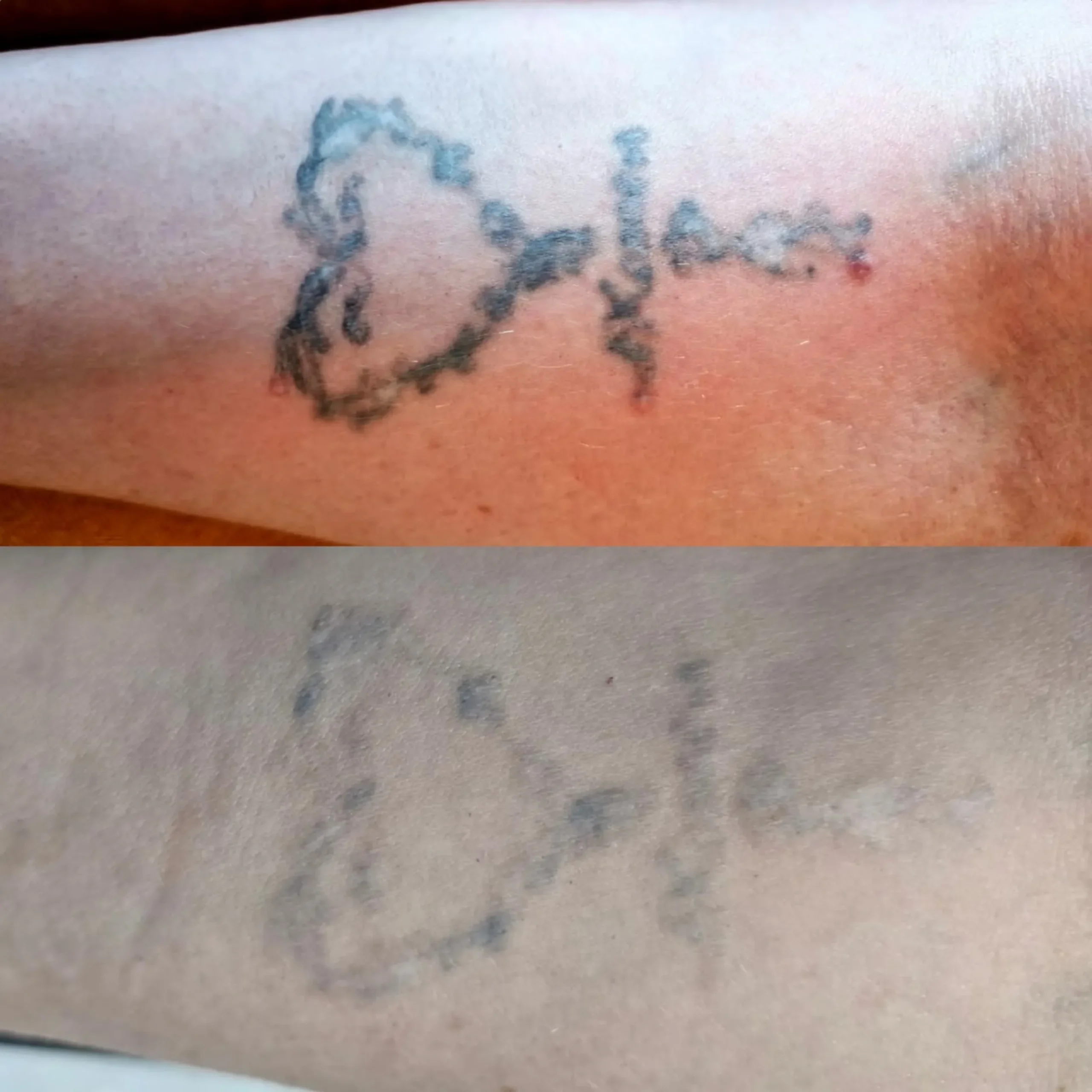 tatoo removal cost